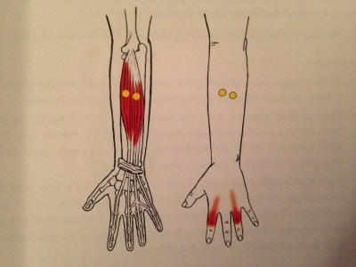 trigger point on forearm