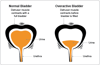 normal vs overactive bladder image