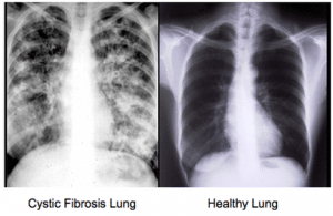 cystic fibrosis lung vs healthy lung xray