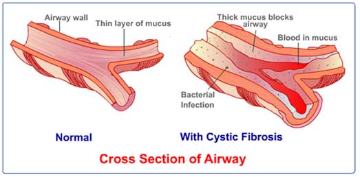 cross section of cystic fibrosis airway vs healthy airway