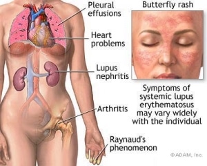 lupus symptoms diagram