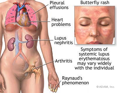 lupus symptoms in a diagram