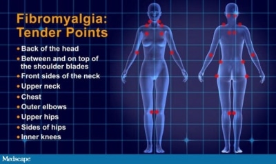 fibromyalgia tender spots chart