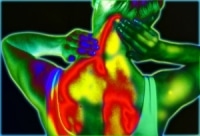 fibromyalgia thermography of back