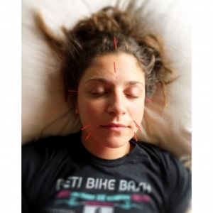 cosmetic acupuncture by boulder acupuncturist caitlin gordon