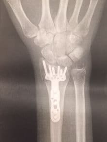 Wrist X-ray with Titanium