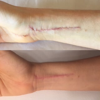 before and after photos of wrist surgical scar to show acupuncture speeds healing