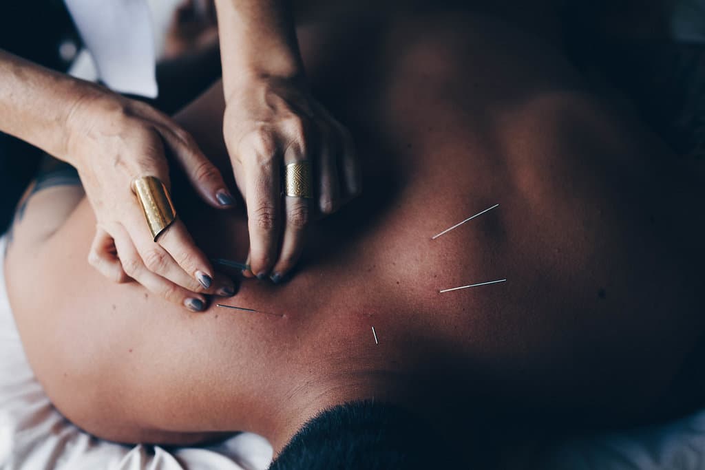 Boulder Dry Needling by boulder acupuncturist Caitlin Gordon amaluna acupuncture dry needling patient with back full of needles