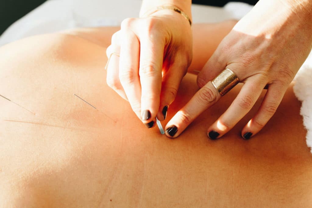 A Female Doctor Performing Acupuncture Treatment- Amaluna wellness