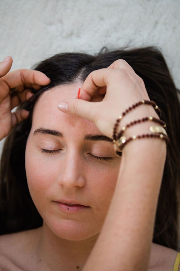 Woman with Facial Rejuvenation Acupuncture - Amaluna Wellness
