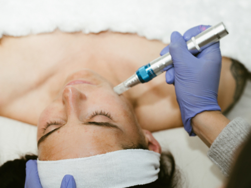 woman with headband on getting microneedling done